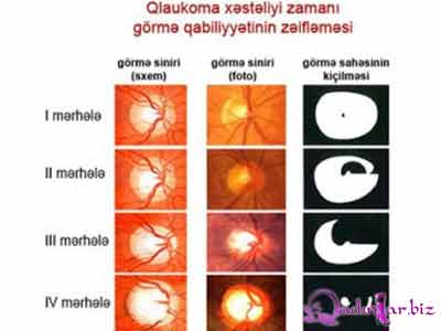 Qlaukomanın simptomları və müalicəsi