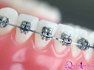 Yetkinlərdə ortodontiya müalicəsi