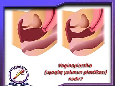 Vaginoplastika (uşaqlıq yolunun plastikası) nədir?