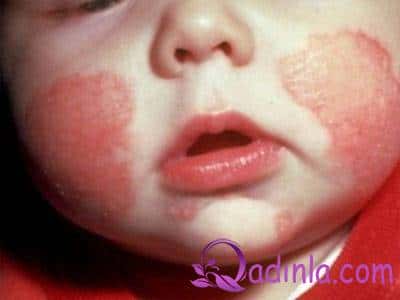 Uşaqlarda allergik diatezlər